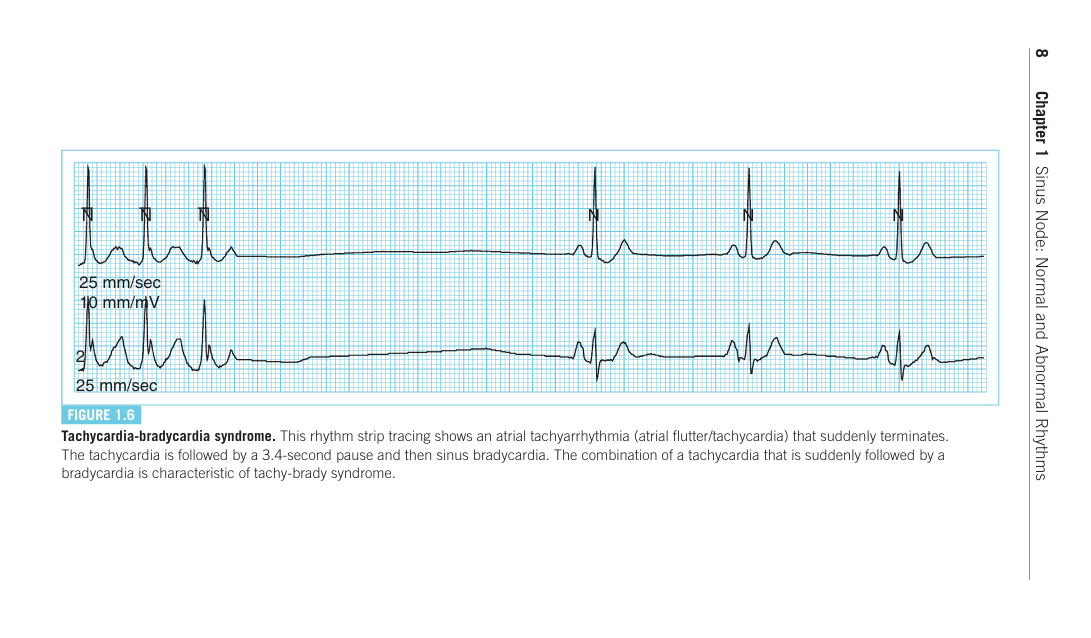 2025-01-04 16_47_26-Arrhythmia Essentials (Brian Olshansky, Mina K Chung etc.).pdf - Personal - Micr