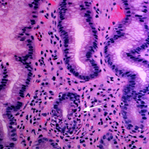 Clinical Pathophysiology, Differential Diagnosis, and Integrative Management of Acute and Chronic Helicobacter pylori Gastritis: A Holistic Medical Perspective