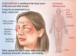 The Harmony of Healing: A Comprehensive Clinical Treatise on Urticaria and Angio-oedema