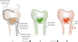 Comprehensive Clinical Analysis of Osteomyelitis: A Multidisciplinary Guide to Pathogenesis, Diagnostics, and Integrative Management