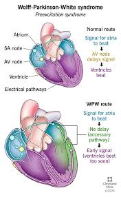 Clinical Electrophysiology, Differential Diagnosis, and Therapeutic Stratification of Wolff-Parkinson-White Syndrome